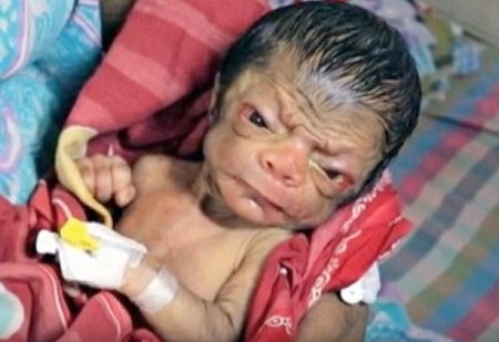 Младенец, похожий на 80 летнего старика, родился в Бангладеш
