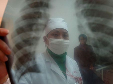 Заболеваемость туберкулезом в Удмуртии снизилась на 10%