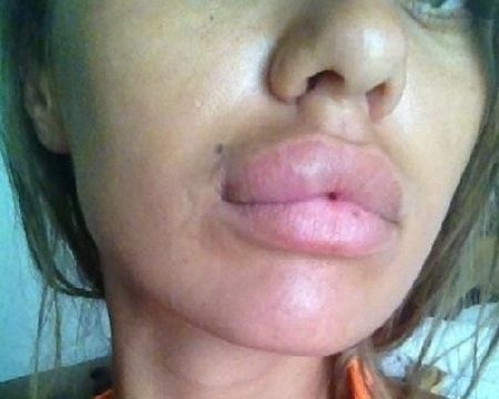 Фото: губы Виктории Бони увеличились вдвое