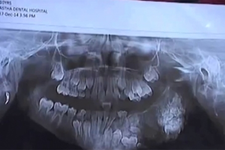 7-летнему мальчику в Индии удалили 80 зубов