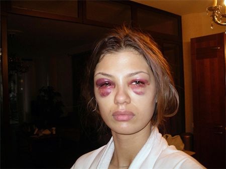 Фото Виктории Бони с синяками на  изуродованном лице попали в Сеть