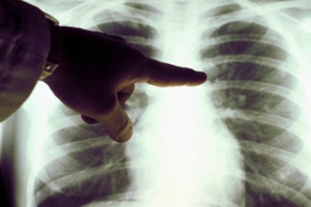 Заболеваемость туберкулезом среди детей Ижевска снизилась в два раза